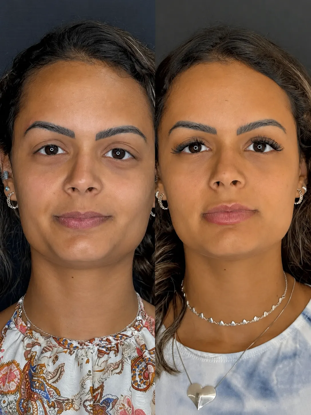 Harmonização Orofacial